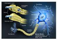 بیماری ام اسMS_Multiple Sclerosis :  MS   چیست ؟